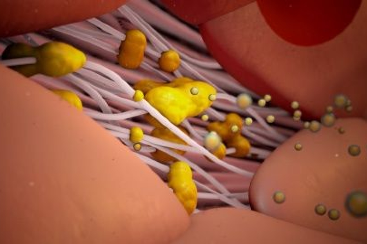 This Common Yet Overlooked Cholesterol Disorder Is Silently Killing Millions Every Year